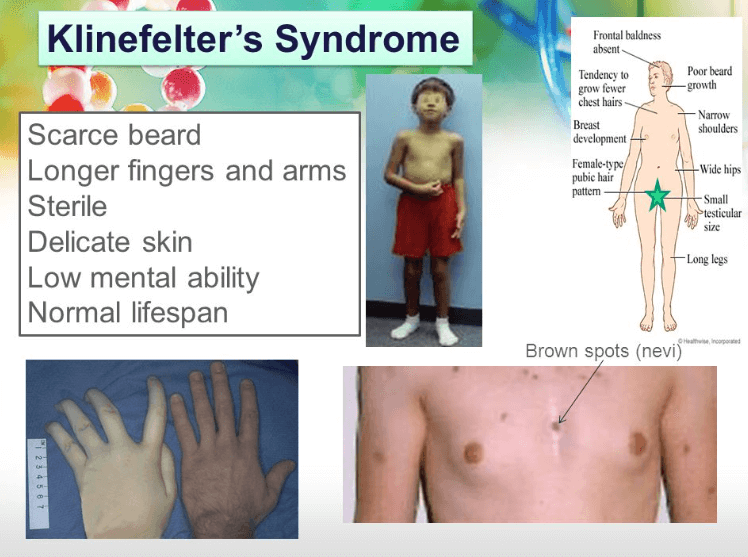 Turner Syndrome and Klinefelter Syndrome - Definition, Differences and its Causes_4.1